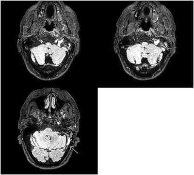 Case Report: Cerebral Venous Sinus Thrombosis and COVID-19 Infection